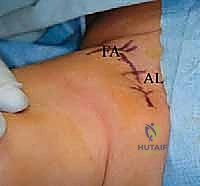 جراحة الرد المفتوح الإنسي لخلع الورك التطوري: دليل شامل للمرضى مع الأستاذ الدكتور محمد هطيف