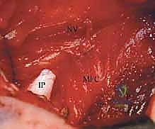 دواعي التدخل الجراحي في خلع الورك