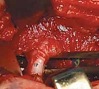 التحضير لعملية الرد المفتوح الإنسي