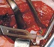 صورة توضيحية لـ جراحة الرد المفتوح الإنسي لخلع الورك التطوري: دليل شامل للمرضى مع الأستاذ الدكتور محمد هطيف