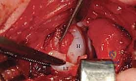 صورة طبية: جراحة الرد المفتوح الإنسي لخلع الورك التطوري: دليل شامل للمرضى مع الأستاذ الدكتور محمد هطيف