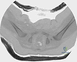 صورة توضيحية لـ جراحة الرد المفتوح الإنسي لخلع الورك التطوري: دليل شامل للمرضى مع الأستاذ الدكتور محمد هطيف