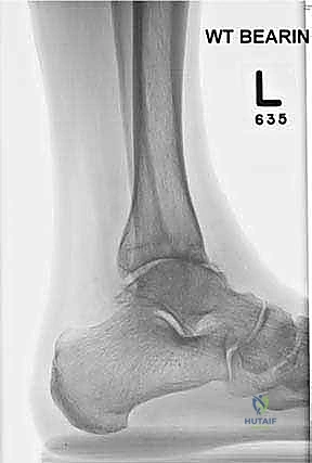 صورة توضيحية لـ استبدال مفصل الكاحل الكلي ستار STAR لعلاج خشونة الكاحل المتقدمة في صنعاء