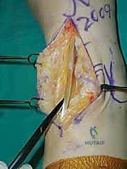 استبدال مفصل الكاحل الكلي ستار STAR لعلاج خشونة الكاحل المتقدمة في صنعاء