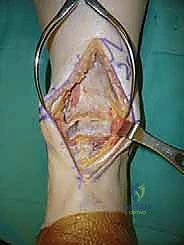 صورة شعاعية توضح التآكل الشديد للمفصل