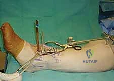 إزالة الزوائد العظمية