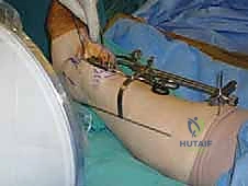 وضع دليل القطع على الساق