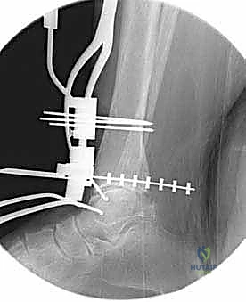 صورة توضيحية لـ استبدال مفصل الكاحل الكلي ستار STAR لعلاج خشونة الكاحل المتقدمة في صنعاء