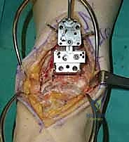 صورة توضيحية لـ استبدال مفصل الكاحل الكلي ستار STAR لعلاج خشونة الكاحل المتقدمة في صنعاء