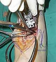 صورة توضيحية لـ استبدال مفصل الكاحل الكلي ستار STAR لعلاج خشونة الكاحل المتقدمة في صنعاء