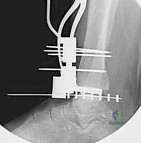 صورة طبية: استبدال مفصل الكاحل الكلي ستار STAR لعلاج خشونة الكاحل المتقدمة في صنعاء