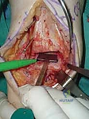 صورة طبية: استبدال مفصل الكاحل الكلي ستار STAR لعلاج خشونة الكاحل المتقدمة في صنعاء