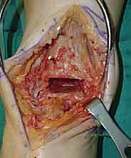 صورة توضيحية لـ استبدال مفصل الكاحل الكلي ستار STAR لعلاج خشونة الكاحل المتقدمة في صنعاء