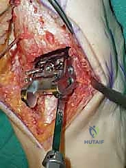 صورة طبية: استبدال مفصل الكاحل الكلي ستار STAR لعلاج خشونة الكاحل المتقدمة في صنعاء