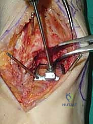 صورة طبية: استبدال مفصل الكاحل الكلي ستار STAR لعلاج خشونة الكاحل المتقدمة في صنعاء