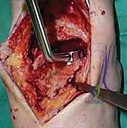 صورة طبية: استبدال مفصل الكاحل الكلي ستار STAR لعلاج خشونة الكاحل المتقدمة في صنعاء