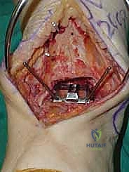 صورة طبية: استبدال مفصل الكاحل الكلي ستار STAR لعلاج خشونة الكاحل المتقدمة في صنعاء