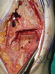 صورة طبية: استبدال مفصل الكاحل الكلي ستار STAR لعلاج خشونة الكاحل المتقدمة في صنعاء