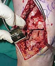 صورة طبية: استبدال مفصل الكاحل الكلي ستار STAR لعلاج خشونة الكاحل المتقدمة في صنعاء