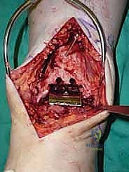 صورة طبية: استبدال مفصل الكاحل الكلي ستار STAR لعلاج خشونة الكاحل المتقدمة في صنعاء