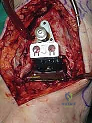 صورة طبية: استبدال مفصل الكاحل الكلي ستار STAR لعلاج خشونة الكاحل المتقدمة في صنعاء