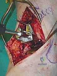 صورة طبية: استبدال مفصل الكاحل الكلي ستار STAR لعلاج خشونة الكاحل المتقدمة في صنعاء