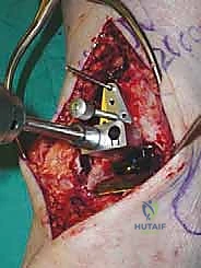 صورة طبية: استبدال مفصل الكاحل الكلي ستار STAR لعلاج خشونة الكاحل المتقدمة في صنعاء