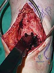Intraoperative Surgical Step