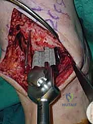 صورة طبية: استبدال مفصل الكاحل الكلي ستار STAR لعلاج خشونة الكاحل المتقدمة في صنعاء