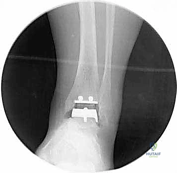 صورة طبية: استبدال مفصل الكاحل الكلي ستار STAR لعلاج خشونة الكاحل المتقدمة في صنعاء