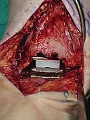 صورة طبية: استبدال مفصل الكاحل الكلي ستار STAR لعلاج خشونة الكاحل المتقدمة في صنعاء