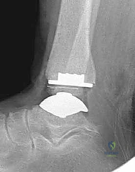 صورة طبية: استبدال مفصل الكاحل الكلي ستار STAR لعلاج خشونة الكاحل المتقدمة في صنعاء