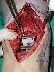 صورة طبية: استبدال مفصل الكاحل الكلي ستار STAR لعلاج خشونة الكاحل المتقدمة في صنعاء