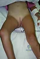 مسارات انتشار العدوى إلى المفصل