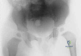 أنواع البكتيريا المسببة لالتهاب المفصل القيحي