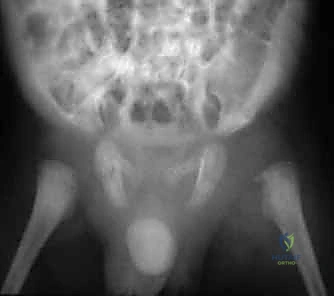 تأثير الضغط على تروية رأس الفخذ