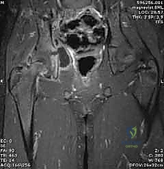 صورة موجات فوق صوتية تظهر تجمع السوائل في المفصل
