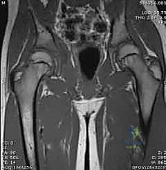 فحص سريري يظهر تقييد حركة مفصل الفخذ