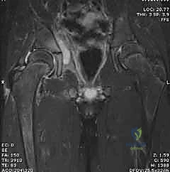 عملية بزل المفصل وسحب السائل الصديدي
