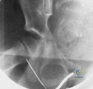 تعقيم وتجهيز منطقة الفخذ للجراحة