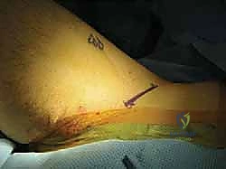 صورة توضيحية لـ تصريف التهاب مفصل الفخذ القيحي عند الأطفال: دليل شامل للآباء