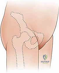 صورة توضيحية لـ تصريف التهاب مفصل الفخذ القيحي عند الأطفال: دليل شامل للآباء