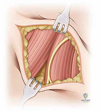 صورة توضيحية لـ تصريف التهاب مفصل الفخذ القيحي عند الأطفال: دليل شامل للآباء