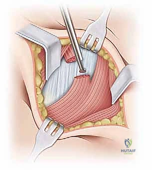 صورة توضيحية لـ تصريف التهاب مفصل الفخذ القيحي عند الأطفال: دليل شامل للآباء
