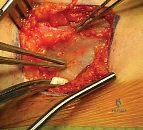 صورة طبية: تصريف التهاب مفصل الفخذ القيحي عند الأطفال: دليل شامل للآباء