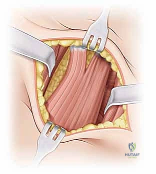 صورة طبية: تصريف التهاب مفصل الفخذ القيحي عند الأطفال: دليل شامل للآباء