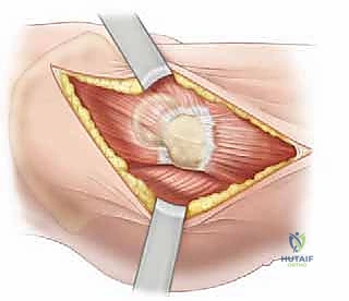 صورة طبية: تصريف التهاب مفصل الفخذ القيحي عند الأطفال: دليل شامل للآباء