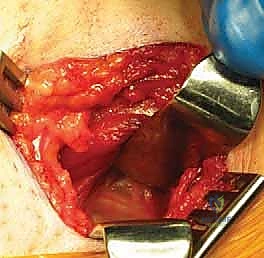 صورة توضيحية لـ تصريف التهاب مفصل الفخذ القيحي عند الأطفال: دليل شامل للآباء