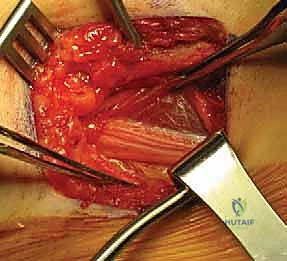 صورة طبية: تصريف التهاب مفصل الفخذ القيحي عند الأطفال: دليل شامل للآباء