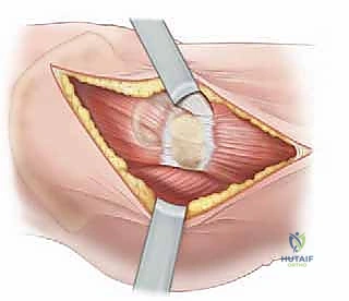 صورة طبية: تصريف التهاب مفصل الفخذ القيحي عند الأطفال: دليل شامل للآباء